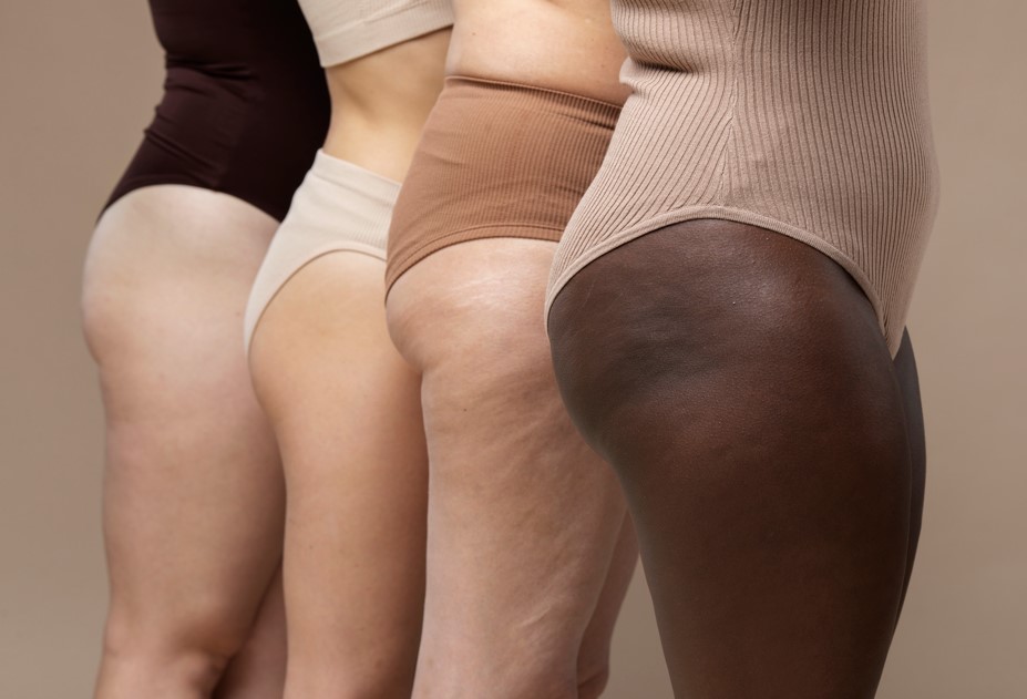 Saúde Feminina: lipedema impacta a saúde vascular de aproximadamente 10% das brasileiras